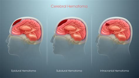 hemmatoma